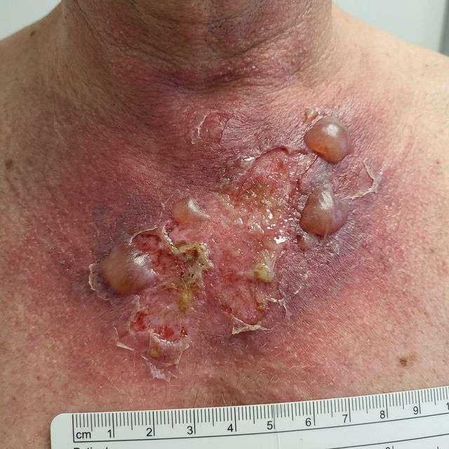 Brûlure de radiothérapie (radiodermatite) sur la peau d'une personne
